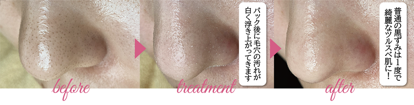 img(普通の黒ずみは1度で綺麗なツルスベ肌に)
